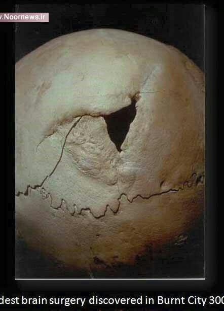 جمجمه یافت شده در شهر سوخته که بر روی آن جراحی صورت گرفته است و قدمت آن به هزاره سوم پیش از میلاد (حدوا 5000 سال) می رسد. 